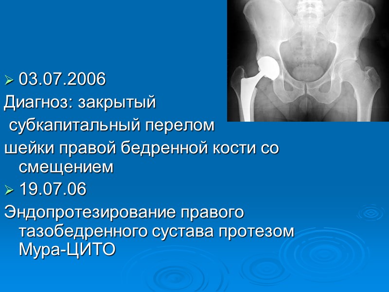 03.07.2006  Диагноз: закрытый  субкапитальный перелом  шейки правой бедренной кости со смещением